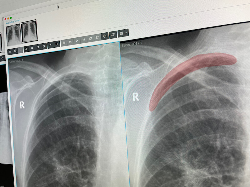 example of AI inferenced X-ray