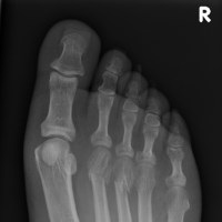 fracture x-ray