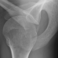 fracture x-ray