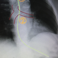 anotated cxr