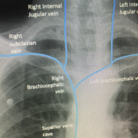 anotated cxr